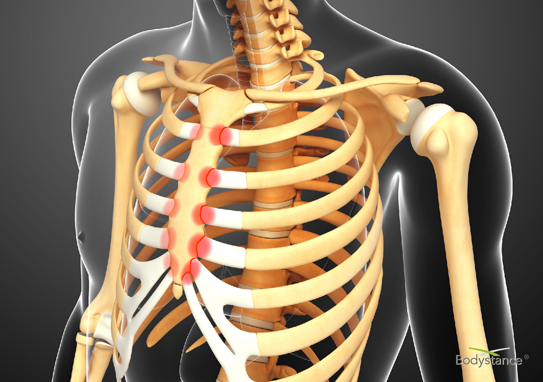 Backpod Helps Costochondritis And Tietze s Syndrome Bodystance
